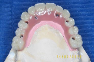 PIB 6 implants